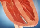 Внутрисердечный кардиостимулятор успешно прошел первый этап испытаний
