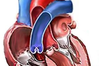 Человеку впервые заменили аортальный клапан сердца, не вскрывая грудную клетку