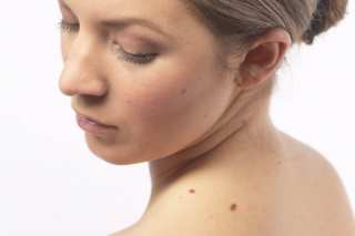 Ученые заявили о прорыве в лечении рака кожи